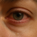 Sensación de ardor, enrojecimiento o sequedad en los ojos.